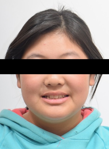 주걱턱 경향 · 비발치교정 치료 전 사진