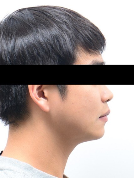 주걱턱 · 양악수술 동반 교정 치료 후 사진