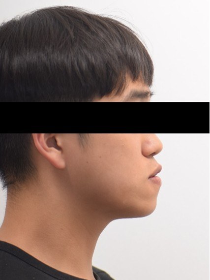 주걱턱 · 양악수술 동반 교정 치료 전 사진