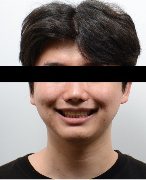 앞니 돌출 · 비발치교정 치료 후 사진