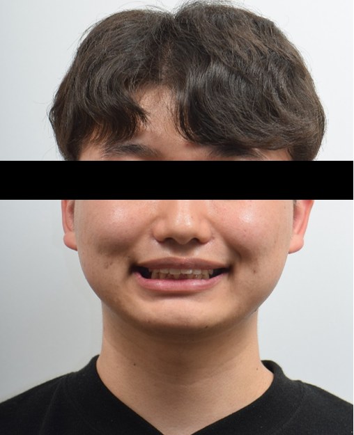 앞니 돌출 · 비발치교정 치료 전 사진