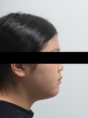 성장기 턱성장 조절 교정 · 1차 치료 후 사진