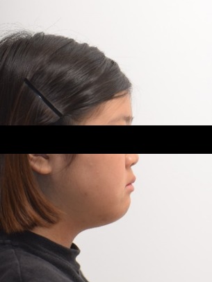 성장기 턱성장 조절 교정 · 1차 치료 전 사진